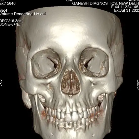 3D CT Head Scan